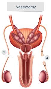 Image result for Vasectomy