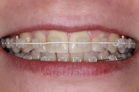 Braces For Young Kids Might Not Always Be Best : Npr