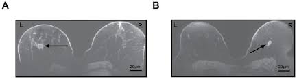 During a breast mri , you lie on your stomach on a padded scanning table. Diagnosis Of Breast Cancer By Magnetic Resonance Imaging Download Scientific Diagram