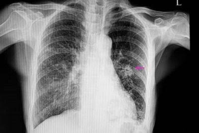 Nódulo Pulmonar Solitário - Cirurgia Torácica do Vale