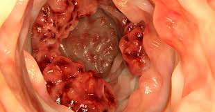 Yes cancer does share some of these symptoms, but there are many others that the doctor can check for that can quickly rule it out. 7 Early Symptoms Of Colon Cancer Most People Miss David Avocado Wolfe