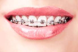 Completed over the course of one or two dentist visits, the procedure involves a strong bleaching agent being applied to lift stains and whiten teeth. How To Keep Your Teeth Whiter With Braces