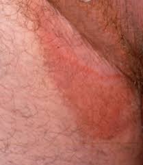 Image result for Erythrasma