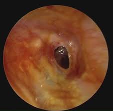 Chronic suppurative otitis media (csom) is a common cause of hearing impairment and disability. Chronic Suppurative Otitis Media Causes Symptoms Diagnosis And Treatment
