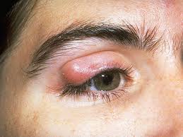 Your doctor or nurse will let you know how to look after your eye after the biopsy. 12 Scary Things Your Eyes Say About Your Health Cbs News