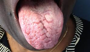 Image result for Fissured tongue