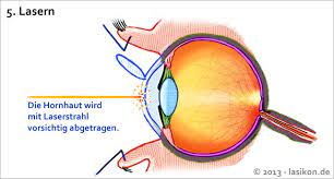 Augen Lasern Lassen Methoden Risiken Beim Augenlasern