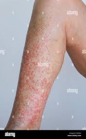 Image result for allergy rash on the legs