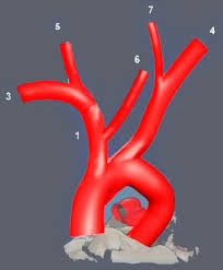 Schematic Diagram Of Lca Arising From Brachiocephalic Trunk 1 Right Download Scientific Diagram The right brachiocephalic vein has a vertical orientation while the left brachiocephalic vein lies.