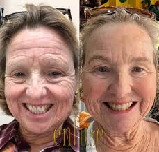 Enfuse Medical Spa™ (@enfusemedicalspa) · Instagram 照片和视频