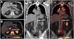 Molecular Imaging Of Inflammation Current And Emerging Technologies For Diagnosis And Treatment Sciencedirect