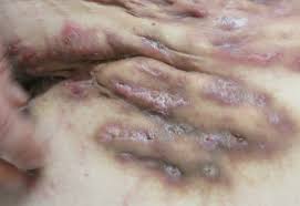 Classically, pharmacologic and surgical therapies have been effective for reducing lesion activity and inflammation, but provide only modest succe … Hidradenitis Suppurativa A Review With An Emphasis On Treatment Consultant360