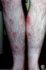 Image result for Panniculitis