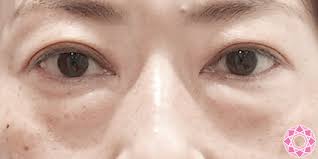 目の下のたるみ取り 症例写真 美容整形のことなら千葉県船橋市の東京形成美容外科 美容皮膚科 船橋駅から徒歩3分