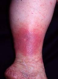 Image result for Lipodermatosclerosis