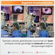 sanilanin aksine gozluklerden kurtulmak icin lazer ameliyati olmak gerektiginde katarakt ameliyati olmaya engel degildir katarakt fako gozicilens ca bilgi