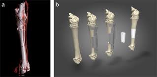 If you'd like to make it easier for your students to remember the components of bones as well as their properties, consider having them make an edible model of a bone. Regeneration Of Segmental Defects In Metatarsus Of Sheep With Vascularized And Customized 3d Printed Calcium Phosphate Scaffolds Scientific Reports