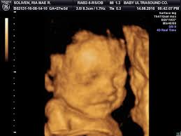Ms. Ria Mae Soliven Baby Girl @ 27 weeks and 3 days