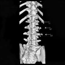 Transverse process fracture is a rare and stable fracture of the spine. Transverse Process Archives Md Direct