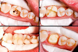 Maybe you would like to learn more about one of these? Root Canal What To Expect Benefits Risks And Costs Ask The Dentist