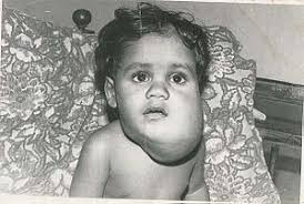 Lymphangioma Wikipedia