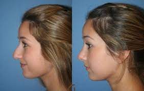 I tried it and it is very easy to use. Rhinoplasty And Nose Job For Android Apk Download