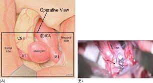 Technical Principles Of Aneurysm Clipping Sciencedirect Aneurysms are commonly found incidentally.
