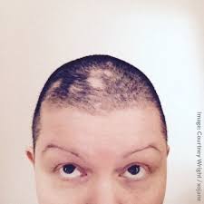 Her clippers had been hanging on the wall, reduced back to mundane things like lining up hairlines and trimming sideburns. Woman Shaves Head To Cope With Trichotillomania