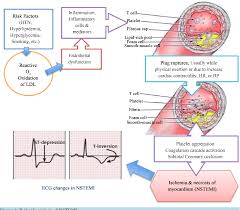 Unlike the other type of acute coronary syndrome, unstable angina, a myocardial infarction occurs when there is cell. Figure 1 From Routine Primary Pci Whether And When Necessary For The Management Of Nstemi An Evidence Based Evaluation Semantic Scholar