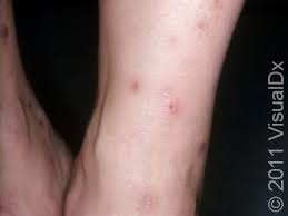 Image result for flea bite