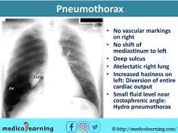 The air accumulation can apply pressure on the lung and make it collapse. Pin On Chest X Ray Interpretation