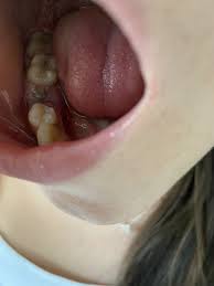 Signs and symptoms of dry socket may include: Is This Dry Socket Mumsnet