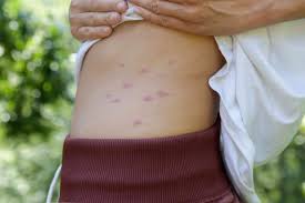 Image result for mosquito bite