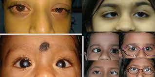 Symptoms That Show Your Child Needs A Paediatric Ophthalmologist