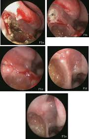 How do you know if you have a nasal polyp? Coblation Assisted Functional Endoscopic Sinus Surgery Improve Prognosis Of The Patients With Chronic Rhinosinusitis And Nasal Polyps