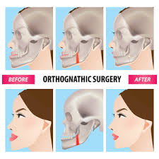 This is a painful condition. How Much Does A Jaw Surgery Cost 2021
