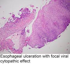 A predictive model was developed based on. Pathology Outlines Herpes Simplex Esophagitis