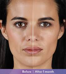 I recently had juvederm 3 injected into my nasolabial folds area, for the first 2 days the result was flawless, i had no longer any smile lines,however after that time, it seems that the product migrated onto the other side of the line leaving me with an even more marked fold.i. Dermal Fillers For Scottsdale Phoenix Az Dr Todd Hobgood