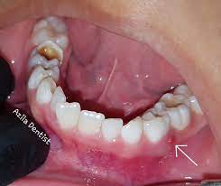 Sakit gigi juga dapat disebabkan oleh adanya gigi yang berlubang. Jangan Ambil Remeh Kalau Gigi Susu Anak Anak Berlubang Infeksi Boleh Merebak Ke Otak Pa Ma