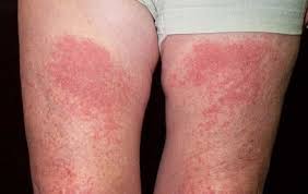 Image result for Photodermatitis