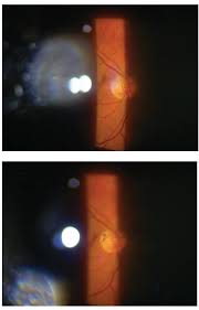 Several drugs may cause eye problems, usually as a result of side effects. Sinking The Floaters