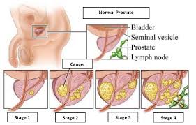 The appearance of aggressiveness under the microscope is described by a gleason score. Prof Dr Baris Bakir