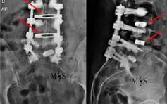Oblique-lateral Lumbar Interbody Fusion (OLIF) - Morgenstern ...