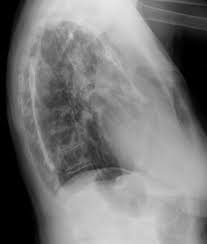 It&#x27;s in the lining of only one side of. Pleural Plaque Pacs Entwicklung