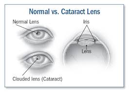 In fact, more than half of all americans age 80 or older either have cataracts or have had surgery to get rid of cataracts. Cataract Symptoms Diagnosis And Treatment Harvard Health