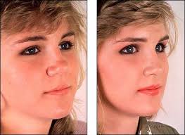 Rhinoplasty Nose Plastic Surgery Plastic Surgery Rhinoplasty Before And After