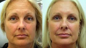 Botox is completely safe to use and has been. Botox Treatments Lehi Botox Injections Saratoga Springs