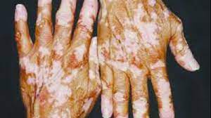 Vitiligo is an acquired, autoimmune disease characterized by depigmented macules and patches on the skin, which occur secondary to melanocyte destruction. Drdo Team Eyes Improved Vitiligo Remedy
