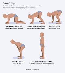 Image result for Muscular Dystrophy