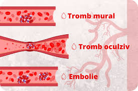 Simptome cheag de sânge la nivelul membrelor. Riscul De TrombozÄ Synevo